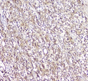 L-Plastin Antibody Human Lymphocytic Tumor IHC. IHC staining of FFPE human lymphocytic tumor tissue with L-Plastin antibody demonstrated widespread cytoplasmic and membranous staining of neoplastic lymphoid cells, consistent with the expression pattern of L-plastin (LCP1), a leukocyte-specific actin-bundling protein involved in immune cell activation and migration. L-plastin serves as a marker of hematopoietic cells and is frequently expressed in lymphoid malignancies. The diffuse staining pattern observed is consistent with the cytoskeletal remodeling and migratory properties characteristic of lymphocytic tumors. Immunostaining was performed with L-Plastin antibody at 1 ug/ml following heat-induced epitope retrieval by boiling tissue sections in pH 6, 10 mM citrate buffer for 10-20 minutes and allowing them to cool before testing.