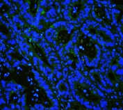 IHC staining of FFPE human intestinal cancer with Caveolin-3 antibody at 1ug/ml (green) and DAPI nuclear stain (blue). HIER: boil tissue sections in pH6, 10mM citrate buffer, for 10-20 min and allow to cool before testing.