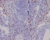 CD8A Antibody Spleen IHC. Immunohistochemistry analysis of CD8 alpha (CD8A) in FFPE human spleen tissue shows membranous staining of cytotoxic T lymphocytes distributed throughout lymphoid regions, consistent with CD8-positive immune cell populations and supporting detection of this tumor immune microenvironment marker in lymphoid tissue. Heat-induced epitope retrieval was performed in pH 6, 10 mM citrate buffer for 10-20 minutes followed by cooling prior to antibody incubation.