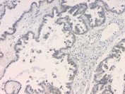 IHC staining of FFPE human ovarian cancer with BCL9L antibody. HIER: boil tissue sections in pH6, 10mM citrate buffer, for 20 min and allow to cool before testing.