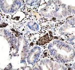 CD235a Antibody in Human Colon Cancer IHC. Immunohistochemistry testing of CD235a Antibody ADOG-7 / Erythroid Marker Antibody in FFPE human colon cancer tissue. Heat-induced epitope retrieval was performed in EDTA buffer, pH 8.0, followed by blocking with 10% goat serum. The antibody was used at 1:100 overnight at 4oC, followed by peroxidase-conjugated goat anti-rabbit IgG and DAB detection. Strong staining is observed predominantly in erythrocytes within vascular spaces, while the surrounding colonic epithelial cells show little staining.