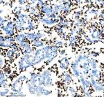 CD235a Antibody in Human Lung Cancer IHC. Immunohistochemistry testing of CD235a Antibody ADOG-7 / Erythroid Marker Antibody in FFPE human lung cancer tissue. Heat-induced epitope retrieval was performed in EDTA buffer, pH 8.0, followed by blocking with 10% goat serum. The antibody was used at 1:100 overnight at 4oC, followed by peroxidase-conjugated goat anti-rabbit IgG and DAB detection. Strong staining is concentrated in numerous small cells consistent with erythrocytes, while the larger tumor epithelial cells show comparatively little immunoreactivity.