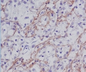 Fibronectin Antibody Liver Cancer IHC. Immunohistochemistry staining of FFPE human liver cancer tissue with Fibronectin antibody. HIER: boil tissue sections in pH8 EDTA for 20 min and allow to cool before testing.