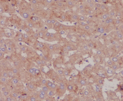 Serum Albumin Antibody Liver IHC. Immunohistochemistry staining of FFPE human liver tissue with Serum Albumin antibody. HIER: boil tissue sections in pH8 EDTA for 20 min and allow to cool before testing.