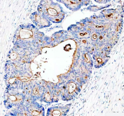 IHC staining of FFPE human colon cancer tissue with MUC13 antibody, HRP-secondary and DAB substrate. HIER: boil tissue sections in pH8 EDTA for 20 min and allow to cool before testing.