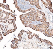 IHC staining of FFPE human thyroid cancer tissue with PPA2 antibody. HIER: boil tissue sections in pH8 EDTA for 20 min and allow to cool before testing.