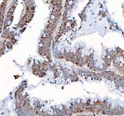 IHC staining of FFPE human colorectal adenocarcinoma tissue with PPA2 antibody. HIER: boil tissue sections in pH8 EDTA for 20 min and allow to cool before testing.