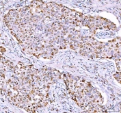 IHC staining of FFPE human breast cancer tissue with PPA2 antibody. HIER: boil tissue sections in pH8 EDTA for 20 min and allow to cool before testing.