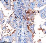 CD54 Antibody DOD-9 in Human Lung Cancer IHC. Immunohistochemistry staining of FFPE human lung cancer tissue with CD54 Antibody clone DOD-9 shows heterogeneous staining, with strong predominantly membranous immunoreactivity in localized tumor regions and weaker staining across much of the surrounding tissue. This Major Rhinovirus Receptor Antibody was applied at 1:50 overnight at 4oC following heat-induced epitope retrieval in EDTA buffer, pH 8.0, and blocking with 10% goat serum. HRP-based detection was performed using DAB chromogen.