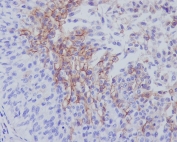 CD141 Antibody / BDCA3 Dendritic Cell Marker. Immunohistochemistry analysis of Thrombomodulin / CD141 (THBD) expression in formalin-fixed, paraffin-embedded human bladder tissue. Using the CD141 Antibody / BDCA3 Dendritic Cell Marker, membranous HRP-DAB brown staining highlights scattered CD141-positive cells with dendritic morphology within the stromal compartment, consistent with BDCA3-positive dendritic cells involved in antigen presentation. Surrounding urothelial cells are largely negative, while occasional vascular endothelial cells also show membranous staining consistent with known thrombomodulin expression. HIER: tissue sections were boiled in pH6, 10mM citrate buffer for 10-20 min followed by cooling prior to staining.