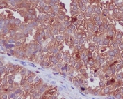 CTSD Antibody Ovarian Carcinoma Immunohistochemistry. IHC staining of FFPE human ovarian cancer with CTSD antibody. HIER: boil tissue sections in pH6, 10mM citrate buffer, for 10-20 min and allow to cool before testing.