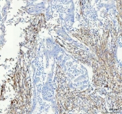 Collagen I Antibody Human Colorectal Adenocarcinoma IHC. IHC staining of FFPE human colorectal adenocarcinoma tissue with Collagen I antibody demonstrated strong extracellular staining within the tumor-associated stroma and fibrotic connective tissue surrounding malignant glandular structures. Collagen I is the major fibrillar collagen of the extracellular matrix and plays critical roles in tissue architecture, mechanical support, and cell-matrix interactions. The prominent stromal staining observed is consistent with desmoplastic extracellular matrix remodeling frequently associated with colorectal adenocarcinoma progression and tumor microenvironment formation. Heat-induced epitope retrieval was performed by boiling tissue sections in pH 8 EDTA buffer for 10-20 minutes and allowing them to cool before testing. These results support the utility of Collagen I Antibody for studies of extracellular matrix biology, tumor stroma development, fibrosis, and cancer-associated tissue remodeling.