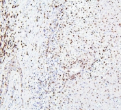 IHC staining of FFPE human testis cancer with CRB1 antibody. HIER: boil tissue sections in pH6, 10mM citrate buffer, for 20 min and allow to cool before testing.