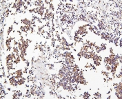 IHC staining of FFPE human glioma with CRB1 antibody. HIER: boil tissue sections in pH6, 10mM citrate buffer, for 20 min and allow to cool before testing.