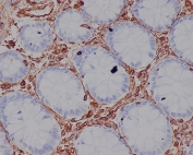 VIM Antibody / Intermediate Filament Assembly Marker Antibody IHC. Immunohistochemistry analysis of FFPE human colon tissue using Vimentin antibody shows strong HRP-DAB brown cytoplasmic staining in stromal and pericryptal mesenchymal cells surrounding colonic glands, with minimal staining in epithelial cells. The staining appears as organized filamentous networks distributed throughout the cytoplasm, consistent with assembled intermediate filament structures. The pattern of Vimentin-positive cells and filament organization supports its role in intermediate filament assembly and cytoskeletal network formation within stromal compartments.