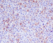 Granzyme B Antibody Human T-Cell Lymphoma IHC. Immunohistochemical staining of FFPE human T-cell lymphoma tissue using Granzyme B Antibody. HIER was performed in pH 6 citrate buffer. An HRP-conjugated secondary antibody with DAB substrate was used for detection. Granzyme B Antibody, a Cytotoxic Lymphocyte Marker Antibody, demonstrates granular cytoplasmic staining in a subset of neoplastic lymphoid cells, consistent with granzyme B expression in cytotoxic T-cell lymphoma.