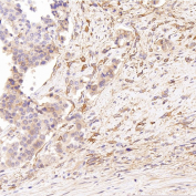 Immunohistochemistry of Glutamine Synthetase Antibody CCH-7 in human prostate carcinoma. Formalin-fixed, paraffin-embedded human prostate cancer tissue demonstrates cytoplasmic HRP-DAB brown staining in malignant epithelial cells, with variable intensity across tumor regions. Adjacent stromal components show comparatively weaker signal. Staining is consistent with Glutamate-ammonia ligase (GLUL) cytoplasmic localization. The antibody was applied at a 1:250 dilution for paraffin-embedded tissue analysis.