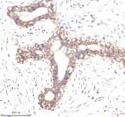 EpCAM Antibody Breast Cancer IHC. Immunohistochemistry staining of FFPE human breast cancer tissue using EpCAM Antibody demonstrates strong membranous and focal cytoplasmic HRP-DAB brown staining within neoplastic epithelial cells forming glandular and duct-like tumor structures. The staining pattern is consistent with expression of Epithelial Cell Adhesion Molecule (EPCAM/CD326), a transmembrane glycoprotein involved in epithelial cell adhesion, tissue organization, and regulation of cellular signaling pathways. Prominent membrane localization highlights the epithelial origin of the tumor cells and is consistent with the established expression of EPCAM in epithelial-derived breast carcinomas. The observed immunoreactivity supports the use of EpCAM as a marker for epithelial differentiation, tumor cell identification, and studies of epithelial tumor biology. HIER: boil tissue sections in pH 8 EDTA buffer for 20 minutes and allow to cool before testing.