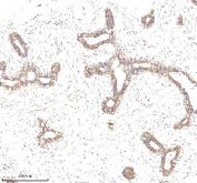EpCAM Antibody Breast Cancer Glandular IHC. Immunohistochemistry staining of FFPE human breast cancer tissue using EpCAM Antibody demonstrates selective membranous HRP-DAB brown staining within neoplastic epithelial cells forming glandular and ductal tumor structures, while the surrounding stromal compartment remains largely negative. The staining pattern is consistent with expression of Epithelial Cell Adhesion Molecule (EPCAM/CD326), a cell surface glycoprotein involved in epithelial cell adhesion, maintenance of tissue architecture, and epithelial differentiation. Strong membrane-associated staining highlights the epithelial phenotype of the tumor cells and supports the established use of EpCAM as a marker of epithelial-derived malignancies. The observed immunoreactivity is useful for studies of tumor cell identification, epithelial lineage characterization, and breast cancer biology. HIER: boil tissue sections in pH 8 EDTA buffer for 20 minutes and allow to cool before testing.