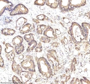 EpCAM Antibody Colon Cancer IHC. Immunohistochemistry staining of FFPE human colon cancer tissue using EpCAM Antibody demonstrates strong membranous and apical HRP-DAB brown staining throughout neoplastic gland-forming epithelial cells. The staining pattern is consistent with expression of Epithelial Cell Adhesion Molecule (EPCAM/CD326), a transmembrane glycoprotein involved in epithelial cell adhesion, tissue organization, and maintenance of epithelial identity. Robust staining of the malignant glandular epithelium contrasts with the relatively weak staining of the surrounding stromal tissue, highlighting the epithelial origin of the tumor cells. The observed immunoreactivity is consistent with the established expression of EpCAM in colorectal epithelial tissues and colorectal carcinomas and supports its use as a marker for epithelial differentiation, tumor cell identification, and epithelial-derived malignancy research. HIER: boil tissue sections in pH 8 EDTA buffer for 20 minutes and allow to cool before testing.