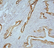 MMP1 Antibody Human Intestinal Cancer IHC. Immunohistochemistry analysis of FFPE human intestinal cancer tissue using MMP1 Antibody / Interstitial Collagenase Antibody. Heat induced antigen retrieval was performed by boiling tissue sections in pH 6 citrate buffer for 20 minutes prior to staining. Strong cytoplasmic and membranous staining is observed in malignant epithelial cells, consistent with MMP1 expression in tumors undergoing extracellular matrix remodeling. These results support the use of MMP1 Antibody / Interstitial Collagenase Antibody for studying interstitial collagenase expression, tumor invasion and cancer-associated extracellular matrix remodeling.