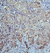 ALDH1A1 Antibody Breast Cancer IHC. Immunohistochemistry analysis of FFPE human breast carcinoma stained with ALDH1A1 Antibody / Cancer Stem Cell and Retinoic Acid Metabolism Marker. Tumor epithelial cells demonstrate moderate to strong cytoplasmic HRP-DAB brown staining for Aldehyde dehydrogenase 1 family member A1 / ALDH1A1, with heterogeneous expression across malignant cell clusters consistent with the known association of ALDH1A1 with stem-like tumor cell populations and metabolic adaptation in breast cancer. Hematoxylin counterstain highlights nuclei in blue. HIER: boil tissue sections in 10 mM citrate buffer, pH6, for 20 min followed by cooling before testing.
