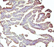 ALDH1A1 Antibody Renal Cancer IHC. Immunohistochemistry analysis of FFPE human renal carcinoma stained with ALDH1A1 Antibody / Cancer Stem Cell and Retinoic Acid Metabolism Marker. Tumor epithelial cells display cytoplasmic and partial membranous HRP-DAB brown staining for Aldehyde dehydrogenase 1 family member A1 / ALDH1A1, consistent with expression of this aldehyde detoxification and retinoic acid metabolism enzyme in renal tumor tissue. Hematoxylin counterstain highlights nuclei in blue. HIER: boil tissue sections in 10 mM citrate buffer, pH6, for 20 min followed by cooling before testing.