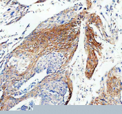Immunohistochemical staining of FFPE human cervical cancer tissue using Connexin 43 antibody. Staining is observed in tumor epithelial cells. Visualization was performed with an HRP-conjugated secondary antibody and DAB substrate, with hematoxylin counterstaining. Heat-induced epitope retrieval was performed using EDTA buffer (pH 8.0).