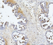 Immunohistochemistry analysis of TIE2 / TEK tyrosine kinase antibody in human ovarian cancer tissue. FFPE human ovarian carcinoma sections demonstrate HRP-DAB brown staining primarily in vascular endothelial cells within the tumor stroma, with membranous and cytoplasmic signal highlighting microvascular structures. Tumor epithelial cells show minimal to weak staining compared to endothelial components. Nuclear hematoxylin counterstain is visible in blue. Heat induced epitope retrieval was performed in 10 mM citrate buffer, pH 6.0, by boiling tissue sections for 20 minutes followed by cooling prior to antibody incubation.