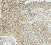 IHC staining of FFPE human lung cancer with Aldolase A antibody. HIER: boil tissue sections in pH6, 10mM citrate buffer, for 20 min and allow to cool before testing.