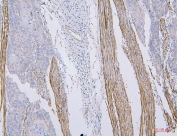 CD35 Antibody Esophagus Squama Cancer IHC. Immunohistochemistry staining of FFPE human esophagus squama cancer tissue with CD35 antibody. HIER: boil tissue sections in pH8 EDTA for 20 min and allow to cool before testing.