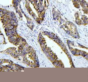 IHC staining of FFPE human colon cancer with Tafazzin antibody. HIER: boil tissue sections in pH8 EDTA buffer for 20 min and allow to cool before testing.