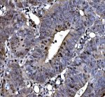 TOP2A Antibody Human Rectal Cancer IHC. Immunohistochemical staining of FFPE human rectal cancer tissue using TOP2A Antibody / Topoisomerase II Alpha Antibody at 2 ug/ml. Heat-induced epitope retrieval was performed using pH 8.0 EDTA buffer, followed by HRP-conjugated secondary antibody detection and DAB chromogen. Predominantly nuclear staining is observed in the tumor cells, consistent with the expected localization of TOP2A in actively proliferating cells. This TOP2A Antibody, also called Topoisomerase II Alpha Antibody, is suitable for studies of cell proliferation, DNA replication, chromosome segregation, and cancer biology.