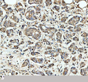 IHC staining of FFPE human breast cancer tissue with SKP1 antibody. HIER: boil tissue sections in pH8 EDTA buffer for 20 min and allow to cool before testing.