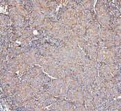 MVP Antibody Breast Cancer IHC. Immunohistochemistry staining of FFPE human breast cancer with MVP antibody. HIER: boil tissue sections in pH6, 10mM citrate buffer, for 20 min and allow to cool before testing.