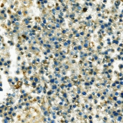 IHC staining of FFPE human testis cancer with HK1 antibody. HIER: boil tissue sections in pH8 EDTA for 20 min and allow to cool before testing.