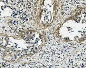 Vinculin Antibody Human Breast Cancer Tissue IF. IHC staining of FFPE human breast cancer with Vinculin antibody. HIER: boil tissue sections in pH8 EDTA for 20 min and allow to cool before testing.