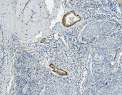 Vinculin Antibody Human Lung Cancer Tissue IHC. IHC staining of FFPE human lung cancer with Vinculin antibody. HIER: boil tissue sections in pH8 EDTA for 20 min and allow to cool before testing.