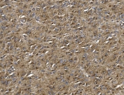 IHC staining of FFPE human glioma with ALDH1L1 antibody. HIER: boil tissue sections in pH8 EDTA for 20 min and allow to cool before testing.