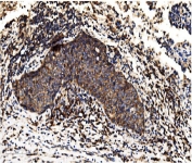 ALPL Antibody Lung Cancer IHC. Immunohistochemistry analysis of FFPE human lung carcinoma tissue stained with ALPL Antibody / Phosphate Metabolism Enzyme Antibody. Tumor epithelial cells demonstrate diffuse cytoplasmic and membranous HRP-DAB brown staining, while surrounding stromal and inflammatory cell populations show comparatively lower background reactivity. The staining pattern is consistent with expression of alkaline phosphatase, tissue-nonspecific isozyme / ALPL, a phosphate metabolism enzyme associated with epithelial differentiation and metabolic remodeling pathways in tumor tissue. HIER: boil tissue sections in pH8 EDTA for 20 min and allow to cool before testing.