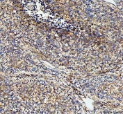 NOX5 Antibody Human Lung Cancer IHC. Immunohistochemical staining of FFPE human lung cancer tissue with NOX5 antibody. Heat-induced epitope retrieval (HIER) was performed by boiling tissue sections in pH 8 EDTA buffer for 20 minutes and allowing them to cool prior to staining. Strong NOX5 immunoreactivity is observed predominantly within the cytoplasm and cell membranes of malignant cells, consistent with the expected localization of this reactive oxygen species enzyme involved in calcium-dependent redox signaling. Cell nuclei are counterstained with hematoxylin (blue).