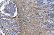 CRYAB Antibody Tumor Survival IHC. Immunohistochemistry of Alpha B crystallin / CRYAB in FFPE human gastric cancer tissue using polyclonal CRYAB antibody. HRP-DAB brown staining highlights cytoplasmic labeling in malignant cells and associated stromal components, with a distribution consistent with stress-adaptive and anti-apoptotic signaling within the tumor microenvironment, while nuclei are counterstained blue. Heat induced epitope retrieval was performed by boiling tissue sections in pH 8 EDTA for 20 min followed by cooling prior to staining.
