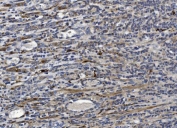 CRYAB Antibody Stromal Tumor IHC. Immunohistochemistry of Alpha B crystallin / CRYAB in FFPE human gastric cancer tissue using polyclonal CRYAB antibody. HRP-DAB brown staining highlights cytoplasmic labeling in spindle-shaped stromal cells and scattered tumor-associated cells, consistent with stress-response and survival signaling within the tumor microenvironment, while surrounding epithelial structures show comparatively lower staining and nuclei are counterstained blue. Heat induced epitope retrieval was performed by boiling tissue sections in pH 8 EDTA for 20 min followed by cooling prior to staining.