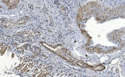 CRYAB Antibody Tumor Microenvironment IHC. Immunohistochemistry of Alpha B crystallin / CRYAB in FFPE human lung cancer tissue using polyclonal CRYAB antibody. HRP-DAB brown staining highlights cytoplasmic labeling in tumor-associated stromal cells and subsets of malignant epithelial cells, consistent with stress-adaptive and anti-apoptotic signaling within the tumor microenvironment, while adjacent non-neoplastic tissue shows reduced staining and nuclei are counterstained blue. Heat induced epitope retrieval was performed by boiling tissue sections in pH 8 EDTA for 20 min followed by cooling prior to staining.