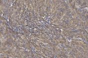 CRYAB Antibody Dermal Tumor IHC. Immunohistochemistry of Alpha B crystallin / CRYAB in FFPE human skin cancer tissue using polyclonal CRYAB antibody. HRP-DAB brown staining highlights diffuse cytoplasmic labeling in spindle-shaped tumor cells, consistent with stress-response and anti-apoptotic signaling in a mesenchymal-like tumor phenotype, while adjacent non-neoplastic epidermal regions show comparatively lower staining and nuclei are counterstained blue. Heat induced epitope retrieval was performed by boiling tissue sections in pH 8 EDTA for 20 min followed by cooling prior to staining.
