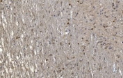 CRYAB Antibody Glioma Survival IHC. Immunohistochemistry of Alpha B crystallin / CRYAB in FFPE human glioma tissue using polyclonal CRYAB antibody. HRP-DAB brown staining highlights cytoplasmic labeling in tumor cells with a diffuse and heterogeneous distribution, consistent with stress-adaptive and anti-apoptotic signaling in neural-derived malignancy, while surrounding non-neoplastic elements show lower staining and nuclei are counterstained blue. Heat induced epitope retrieval was performed by boiling tissue sections in pH 8 EDTA for 20 min followed by cooling prior to staining.