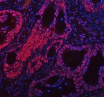 FOXP1 Antibody Human Intestinal Cancer IF. Immunofluorescent staining of paraffin-embedded human intestinal cancer tissue using FOXP1 Antibody / Forkhead Transcription Factor Antibody. Following heat-induced epitope retrieval in pH 8.0 EDTA buffer, the tissue was stained with FOXP1 antibody at 5 ug/ml and detected with a Fluoro550-conjugated secondary antibody (red), while nuclei were counterstained with DAPI (blue). Strong nuclear fluorescence is observed throughout the malignant epithelial cells, consistent with the expected localization of the FOXP1 transcription factor. This FOXP1 Antibody, a Forkhead Transcription Factor Antibody, is suitable for immunofluorescence studies of transcriptional regulation, intestinal cancer biology and tumor biomarker expression.