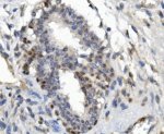 FOXP1 Antibody Human Mammary Cancer IHC. Immunohistochemical staining of paraffin-embedded human mammary cancer tissue using FOXP1 Antibody / Forkhead Transcription Factor Antibody. Following heat-induced epitope retrieval in pH 8.0 EDTA buffer, the tissue was stained with FOXP1 antibody at 2 ug/ml and visualized using a biotinylated secondary antibody with DAB chromogen. Distinct nuclear staining is observed in tumor cells, consistent with the transcription factor function and expected subcellular localization of FOXP1. This FOXP1 Antibody, a Forkhead Transcription Factor Antibody, is suitable for immunohistochemical studies of transcriptional regulation, breast cancer biology and tumor biomarker expression.