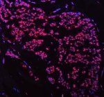 FOXP1 Antibody Human Breast Cancer IF. Immunofluorescent staining of paraffin-embedded human breast cancer tissue using FOXP1 Antibody / Forkhead Transcription Factor Antibody. Following heat-induced epitope retrieval in pH 8.0 EDTA buffer, the tissue was stained with FOXP1 antibody at 5 ug/ml and detected with a Fluoro550-conjugated secondary antibody (red), while nuclei were counterstained with DAPI (blue). Strong nuclear fluorescence is observed in tumor cells, consistent with the expected localization of the FOXP1 transcription factor. This FOXP1 Antibody, a Forkhead Transcription Factor Antibody, is suitable for immunofluorescence studies of transcriptional regulation, breast cancer biology and tumor biomarker expression.