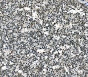 IHC staining of FFPE human melanoma with HOXD11 antibody. HIER: boil tissue sections in pH8 EDTA for 20 min and allow to cool before testing.